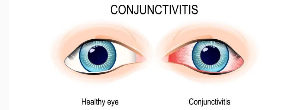 Pink Eye or Conjunctivitis