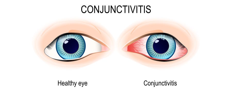 Pink Eye or Conjunctivitis