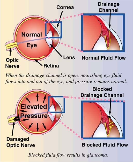 Causes of Glaucoma