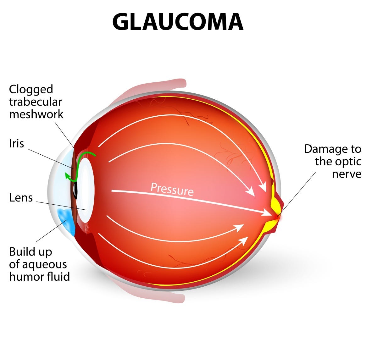 What is Glaucoma