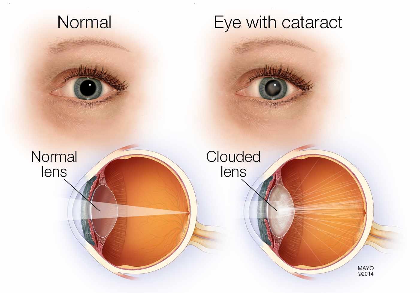 Cataract Eye Disease