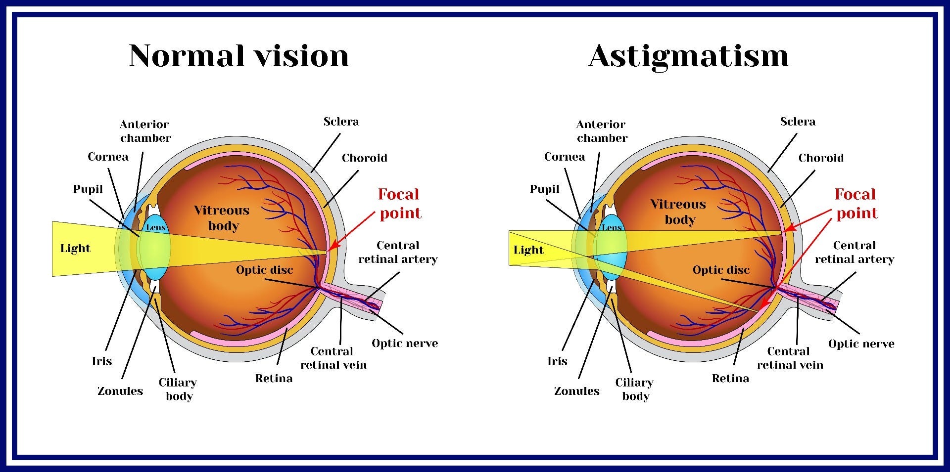 Cornea Concern: How To Correct Your Astigmatism For A Clear Vision